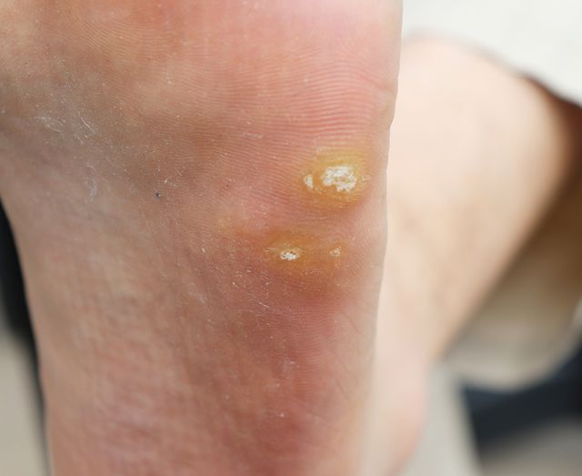사마귀 치료 전