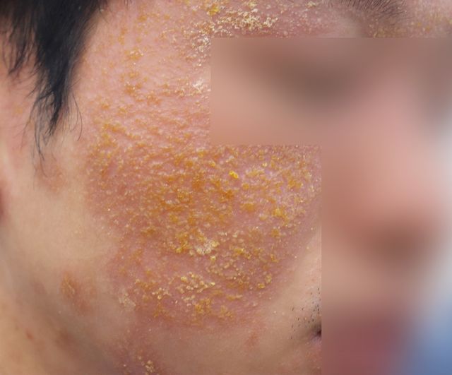 아토피 치료 전
